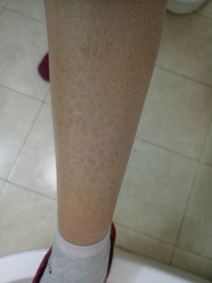 患有严重鱼鳞病的女生有没有可能结婚?