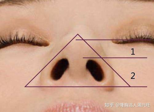 鼻中隔偏器导致的布控不对称