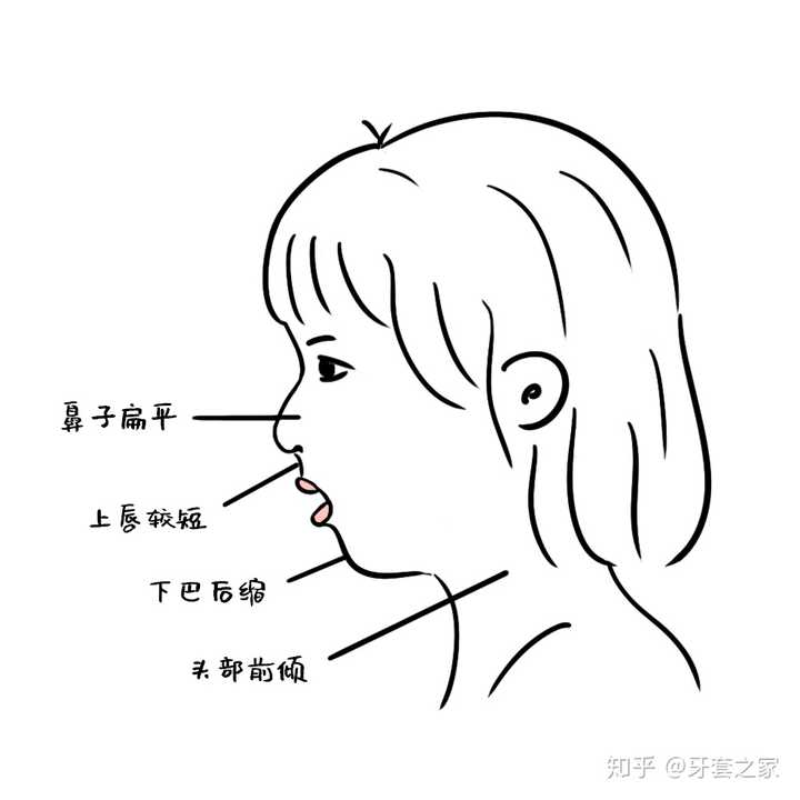 口呼吸面容成年后可以矫正吗?