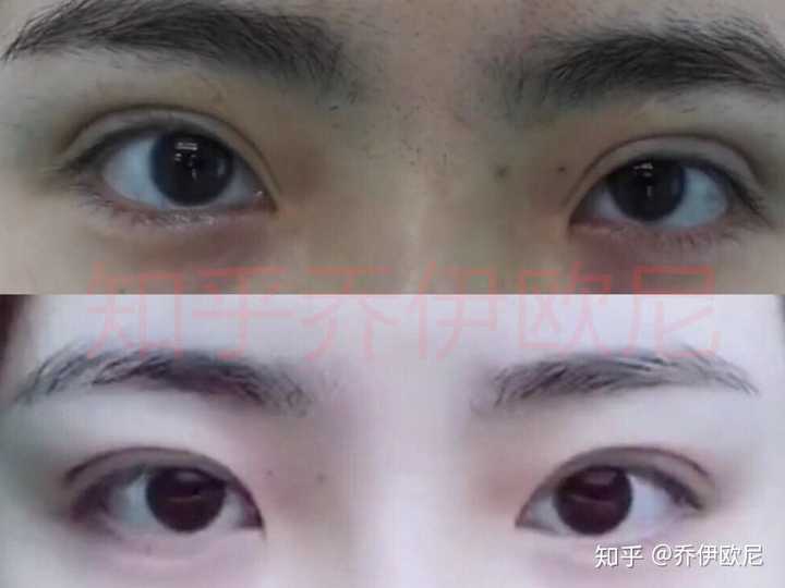 看似眼头开过了,需要修复眼头,降褶后自然包眼角了.