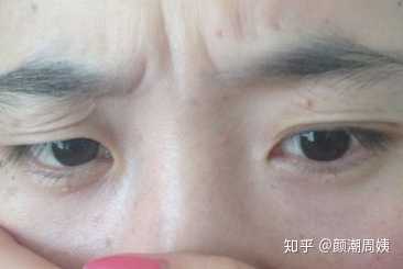 年轻女生眼皮松弛怎么办?