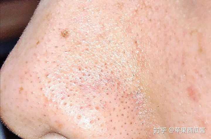 学生党怎样去除黑头?