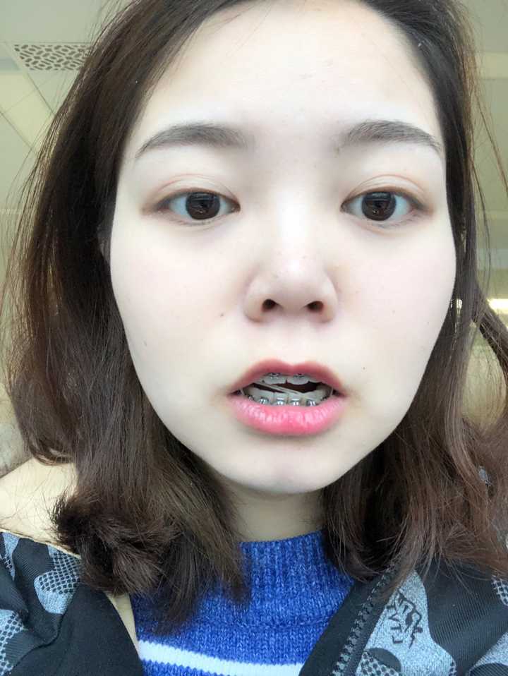 为何戴牙套会形成牙套脸?