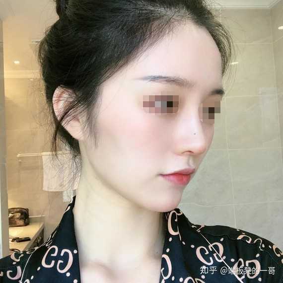 广州有没有做隆鼻自然的医院医生推荐 还有价格?