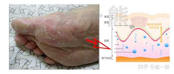 【浸渍型】:当寄生真菌已达真皮层,脚汗增多,脚底出现蜂窝状凹凸.