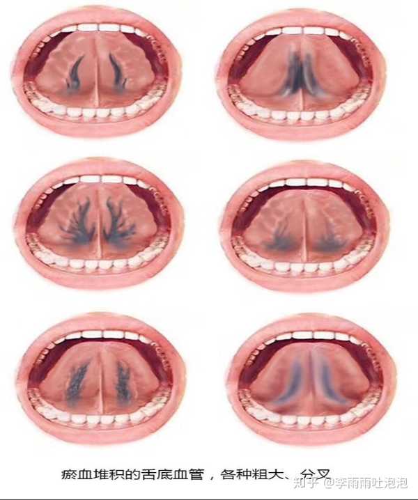 好多人还有瘀血这种症状,养生小仙女们,观察舌下静脉血管是否又黑又粗