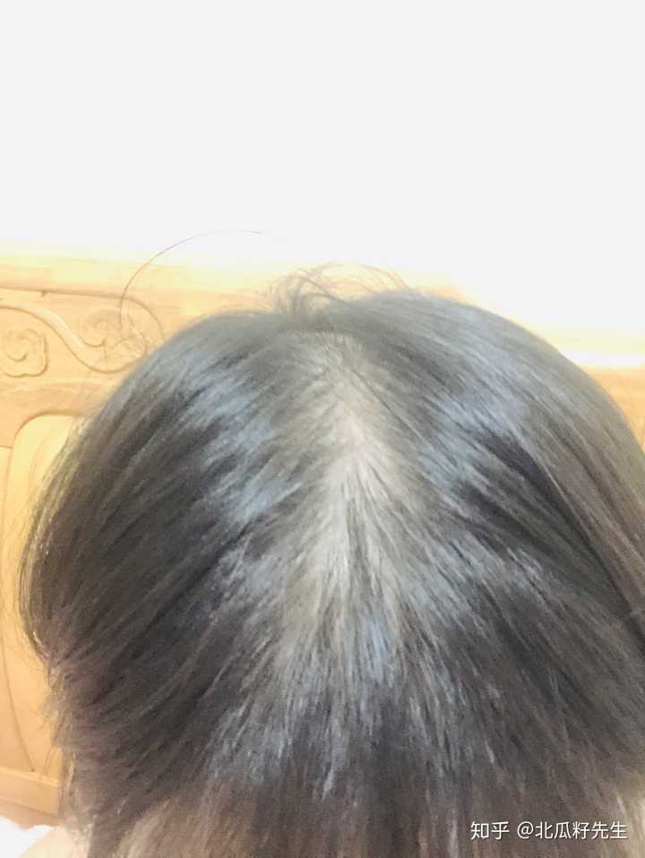 天天长期戴假发会伤害头皮吗或会出现其他问题?