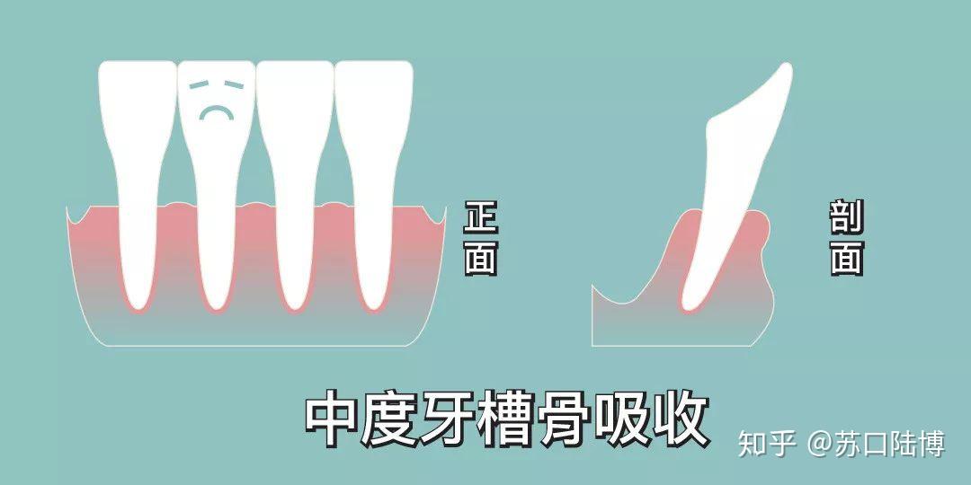 牙槽骨的高度下降三分之一(还剩三分之二)称为轻度吸收