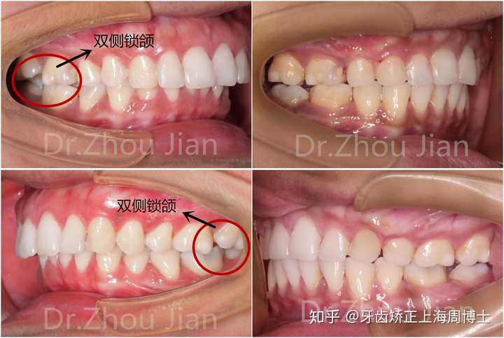 医生建议拔两颗牙,说否则整完会龅牙,但是拔牙听说会造成面部凹陷等