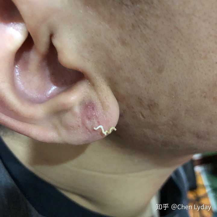 挤黑头有多爽?