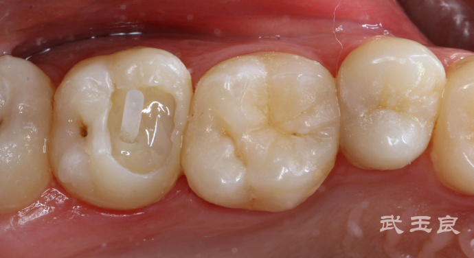 牙齿缺失的危害具体有多大?
