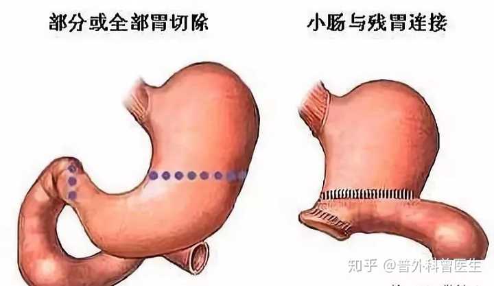 全胃切除也是比较常见的手术方式