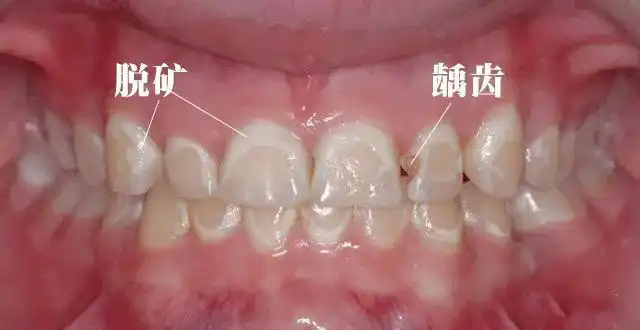 牙齿表面的牙釉质本身非常坚硬,会牙本质起到保护作用,但是如果脱矿