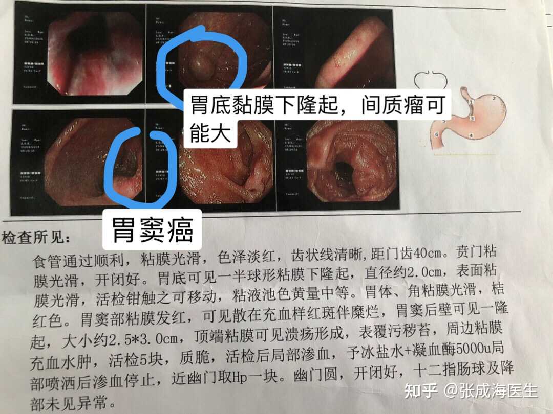 张成海医生 的想法: 胃间质瘤合并胃窦癌 这两个疾病