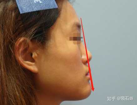 较轻松 参考下图,这是比较明显的凹面型的脸—侧面看起来比较像月亮