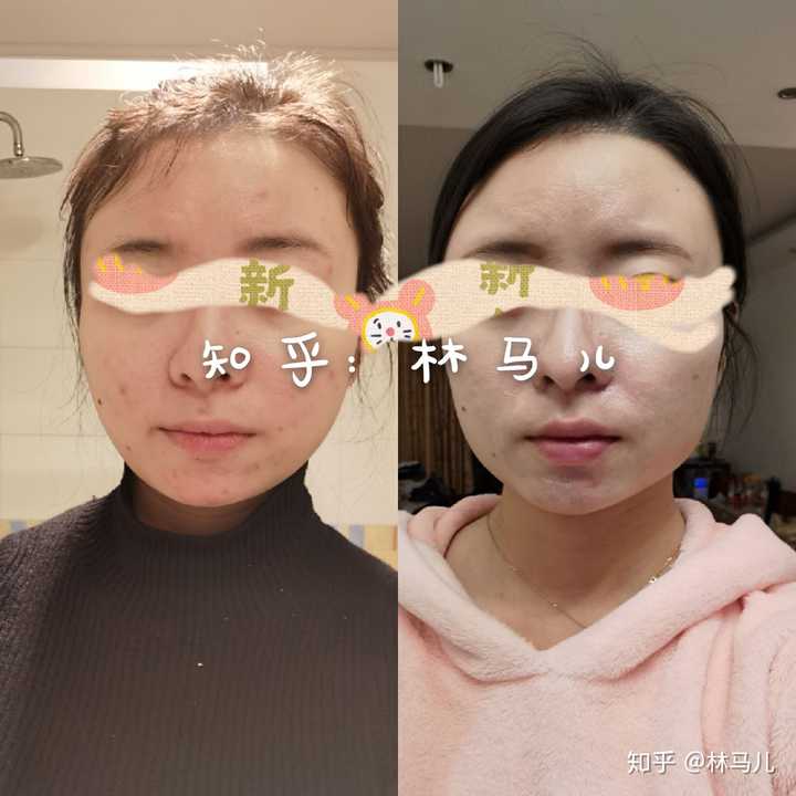 打瘦脸针会后悔吗?