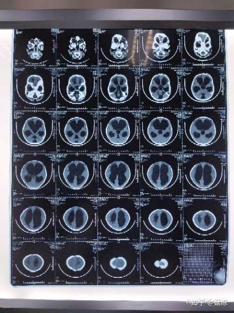 如何帮助一个重度脑积水的孩子?