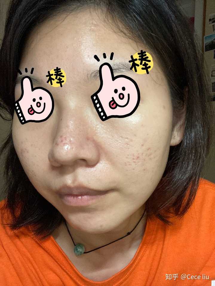tca祛痘坑和点阵激光比哪个效果好?