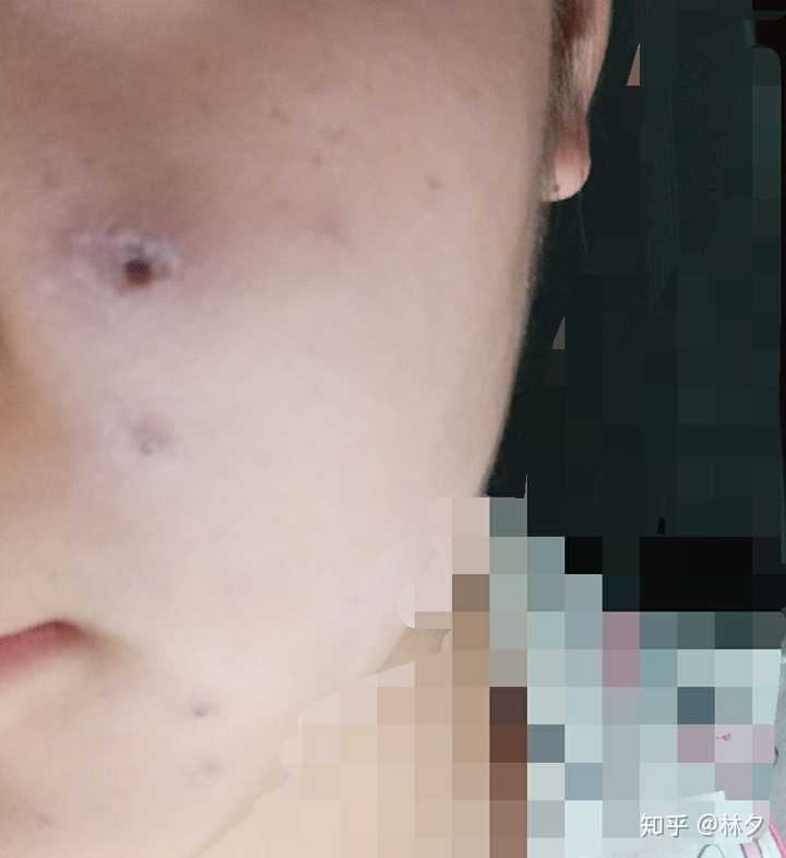 圈住的那个是涂药不小心戳破的水痘 后期变成暗暗的小坑了 这会儿