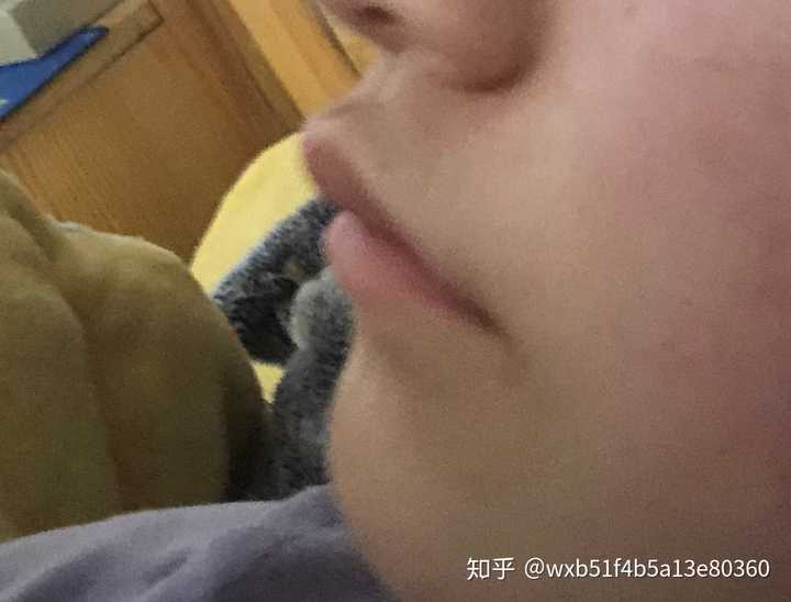上嘴唇上翘,上翻怎么办?侧面看起来简直丑哭我!