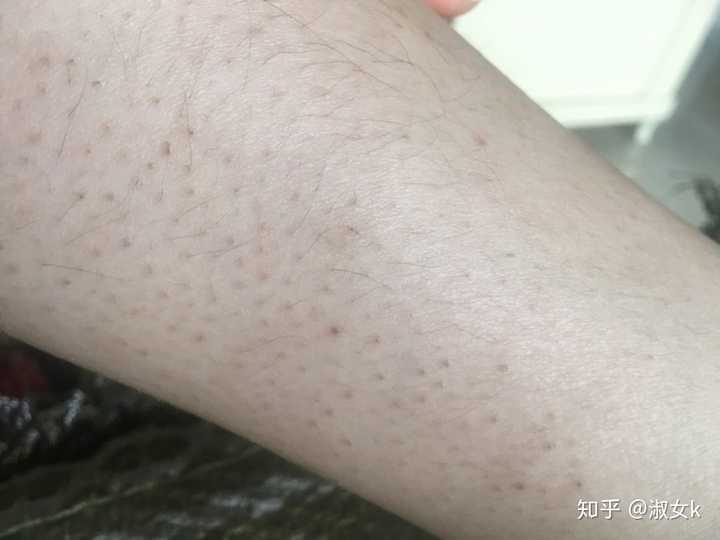 女生又有鸡皮又有腿毛应该先脱毛还是先去鸡皮?