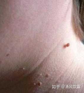丝状疣:这中基本出现是在颈部,额头部位,疣体表现细长,上大下小链接