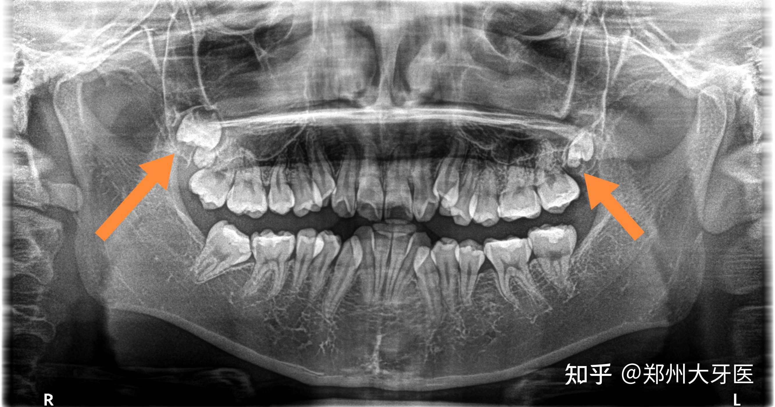 郑州大牙医 的想法: 高位智齿,紧贴上颌窦,风险比较高