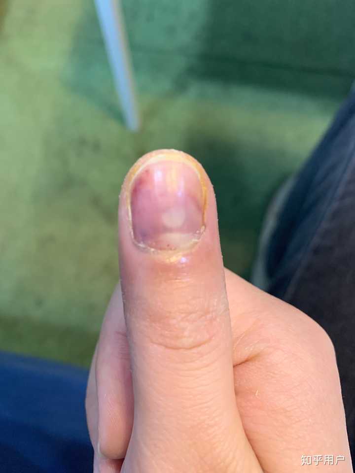 手指甲被夹到,过了一段时间,有黑色的淤血,怎么处理?