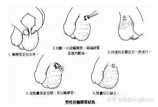 呢 公平起见 我们把男女结扎进行了对比 男人的结扎是通过切断输精管