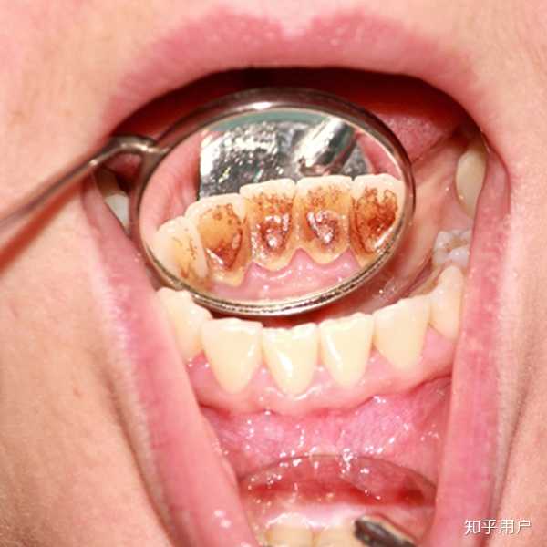 同理在洗牙中,烟斑茶垢色素沉积,去除以后是感觉牙齿干净多