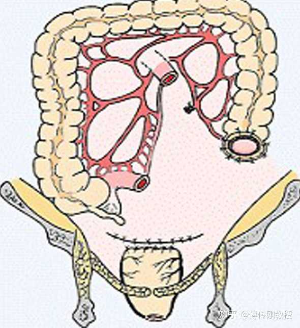 因为肛门没有挖除,所以有一部分直肠癌患者行hartmann手术后,过一段