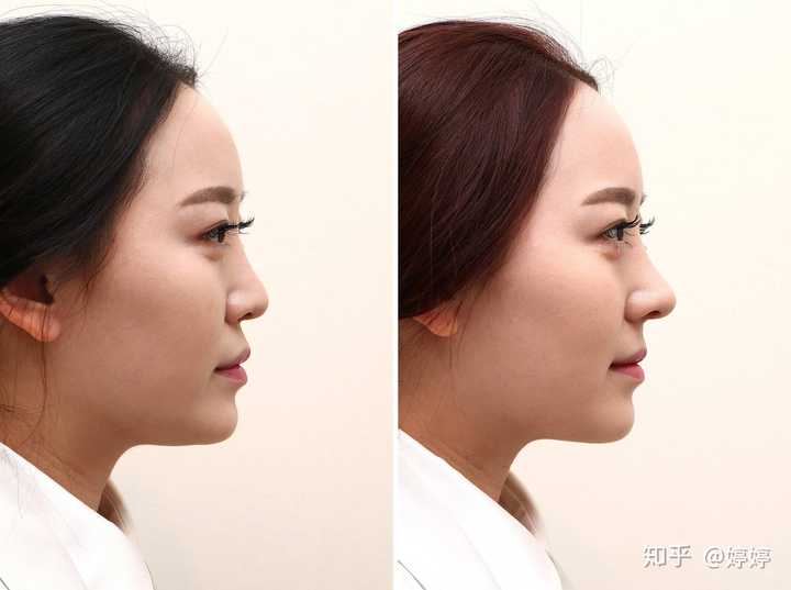 肋软骨隆鼻有什么后遗症?