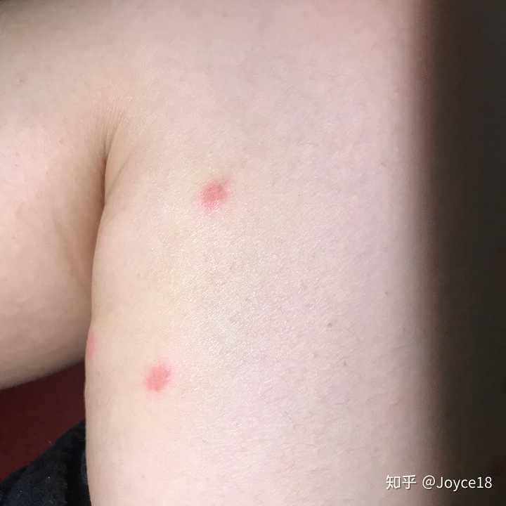 最近身上长了很多红包,特别痒,如图,感觉不像是蚊虫咬