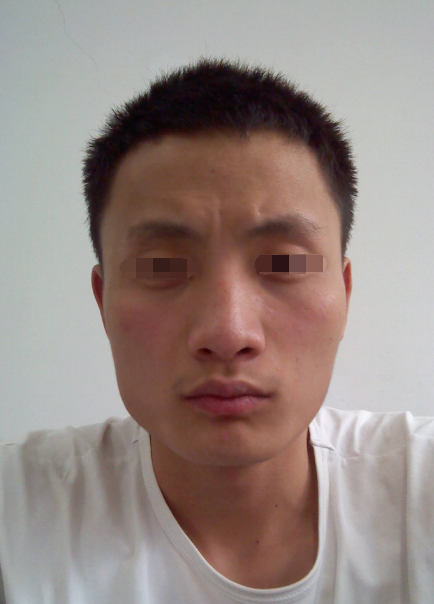 瘦脸针只针对咬肌肥大.