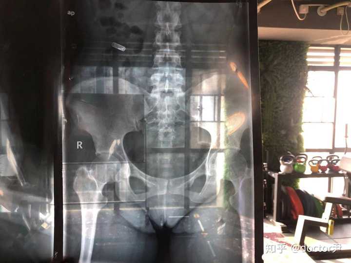 一位患者的骨盆正位片