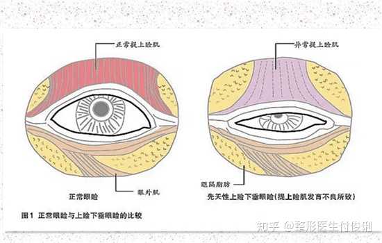 双眼皮提肌效果是永久的吗?