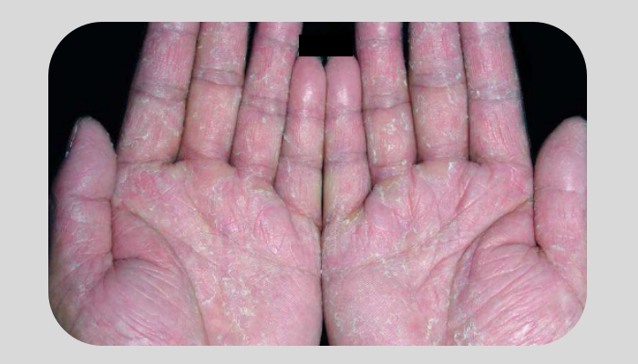 抗真菌的药物进行治疗,它具有传染性,可由足癣和足部的灰指甲传染而来