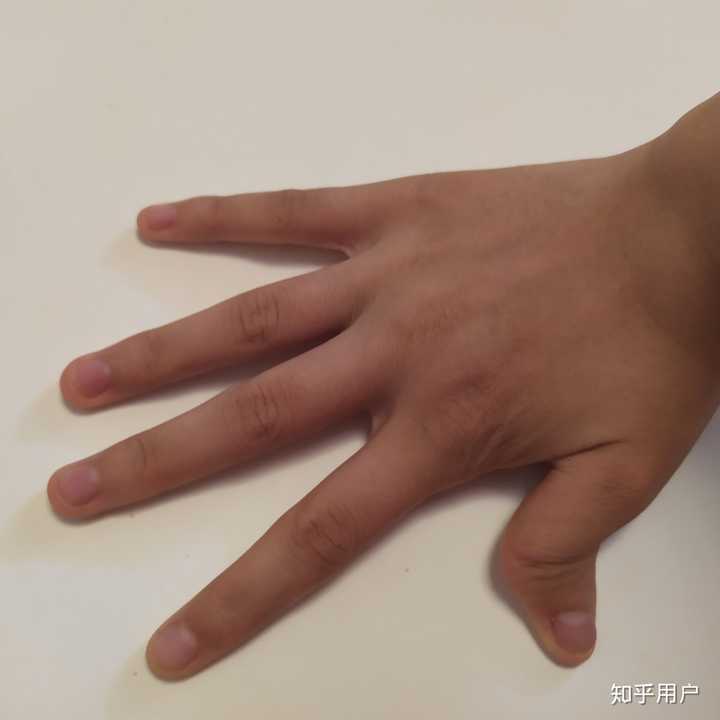 一只手有六个手指头是一种什么样的体验?