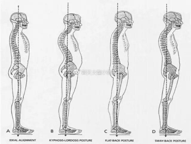 骨盆前倾和骨盆前移有什么区别