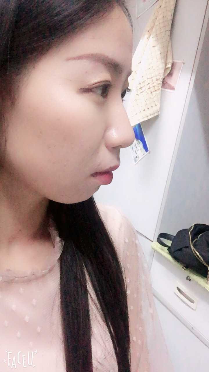 凸嘴没下巴怎么办?