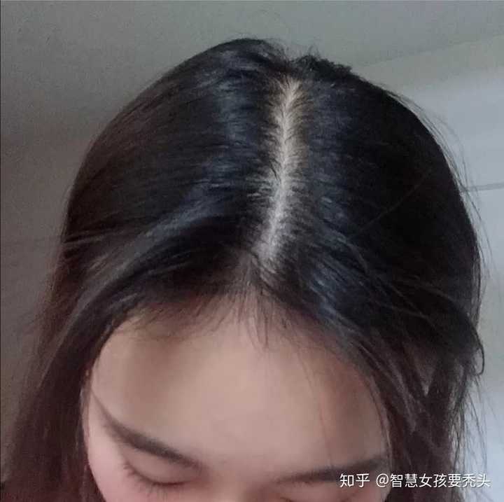 20岁的女生脱发成这样还有救吗?