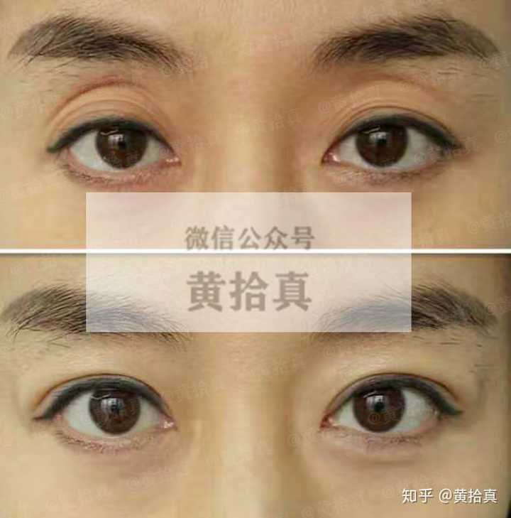 三角眼和上睑的皮肤松弛