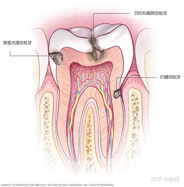 蛀牙的四个阶段:浅龋,中龋,深龋和牙髓炎