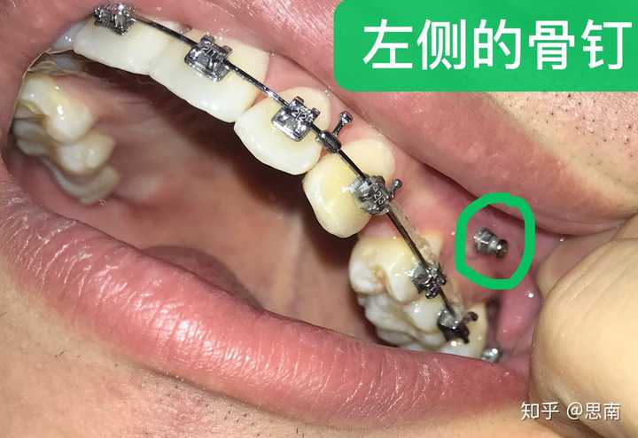 25 岁后去矫正牙齿(戴牙套)是什么体验?