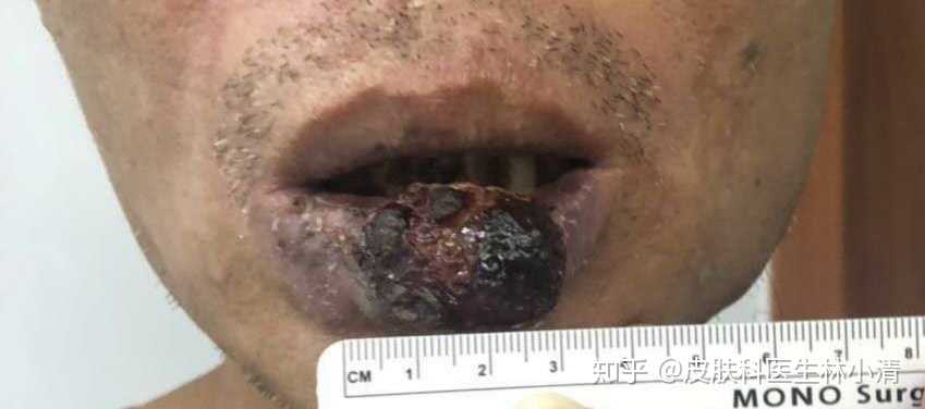 唇部鳞状细胞癌,直接达3cm,属于恶性肿瘤,有转移性,这个需要及时手术