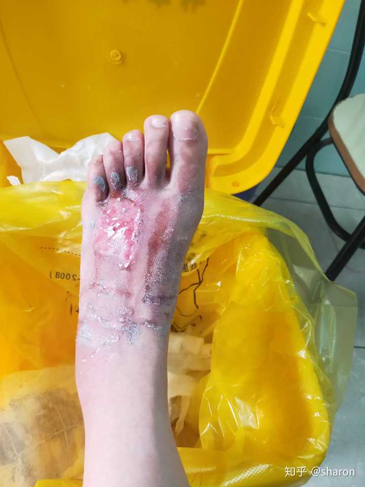 被开水烫伤怎么处理?