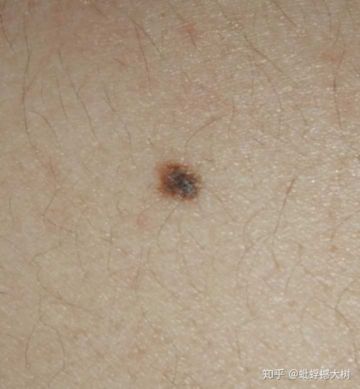 黑痣和黑色素瘤有什么联系?