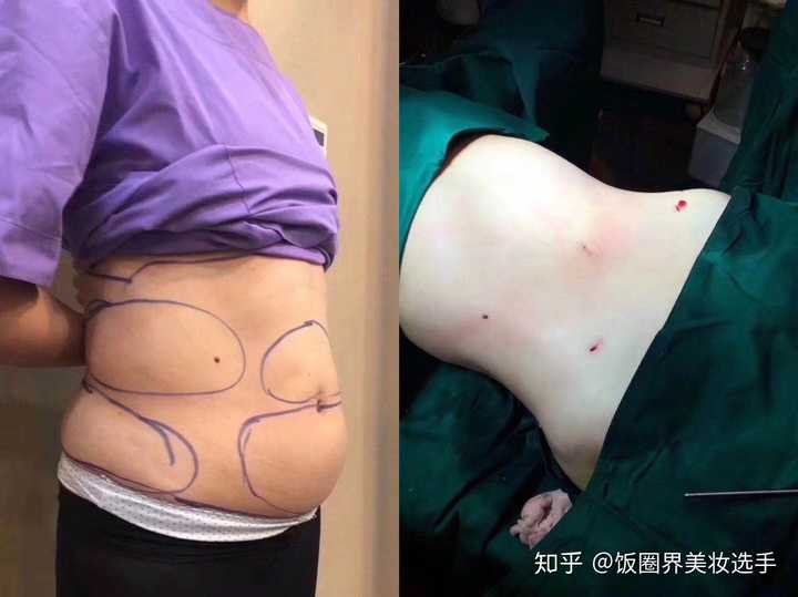 医生打版腰腹吸脂案例