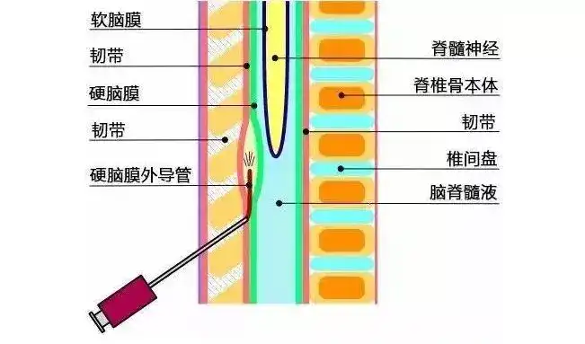 生孩子到底有多疼,可不可以无痛分娩?