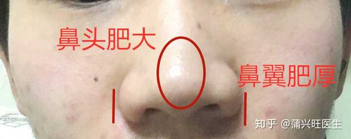 首先我们来看看鼻头肥大的问题